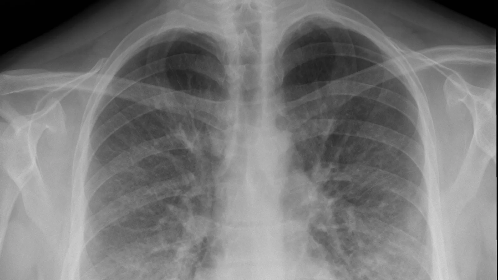 A chest X-ray taken of a early victim of EVALI in Utah; Credit: AP